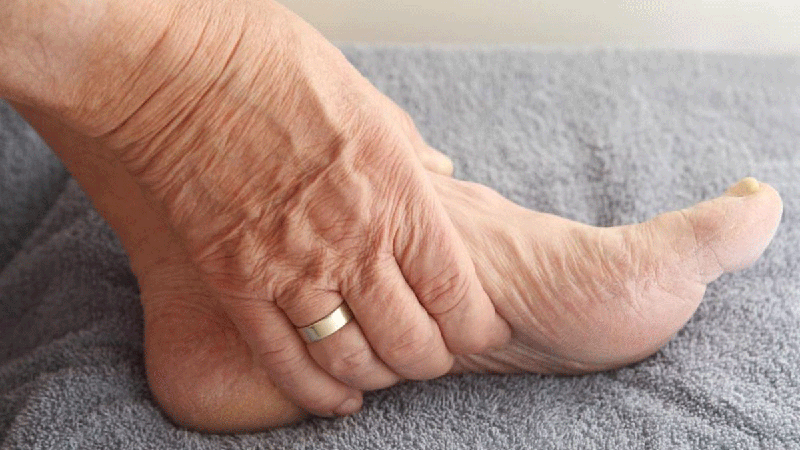 This swelling, known as edema, occurs when the heart is unable to pump blood effectively, leading to fluid buildup.